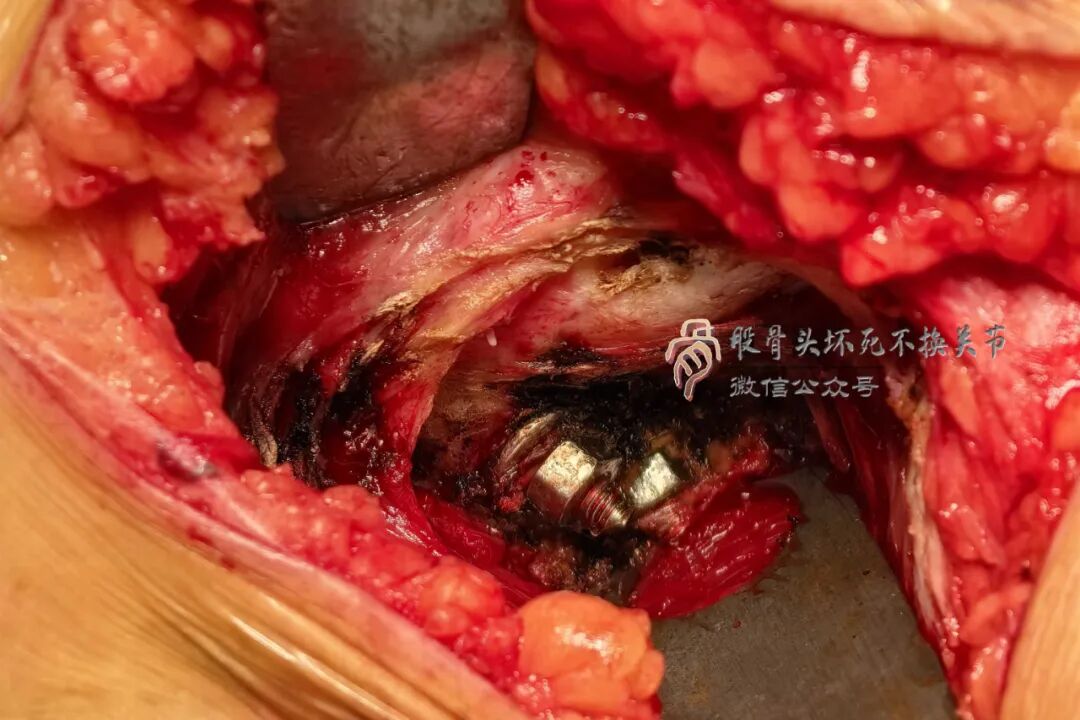 34张图文详解：21年融合髋THA的几点体会