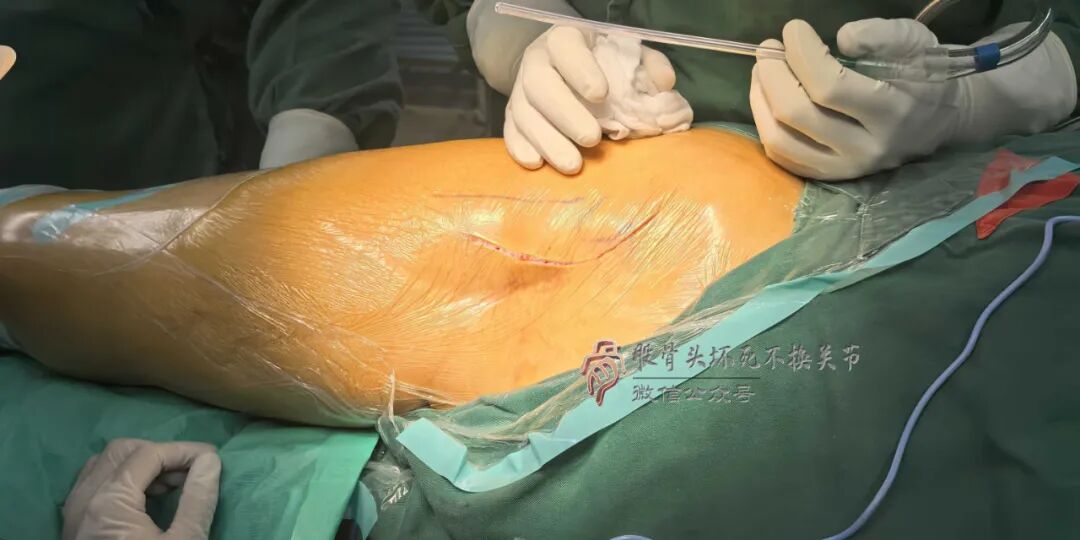 34张图文详解：21年融合髋THA的几点体会