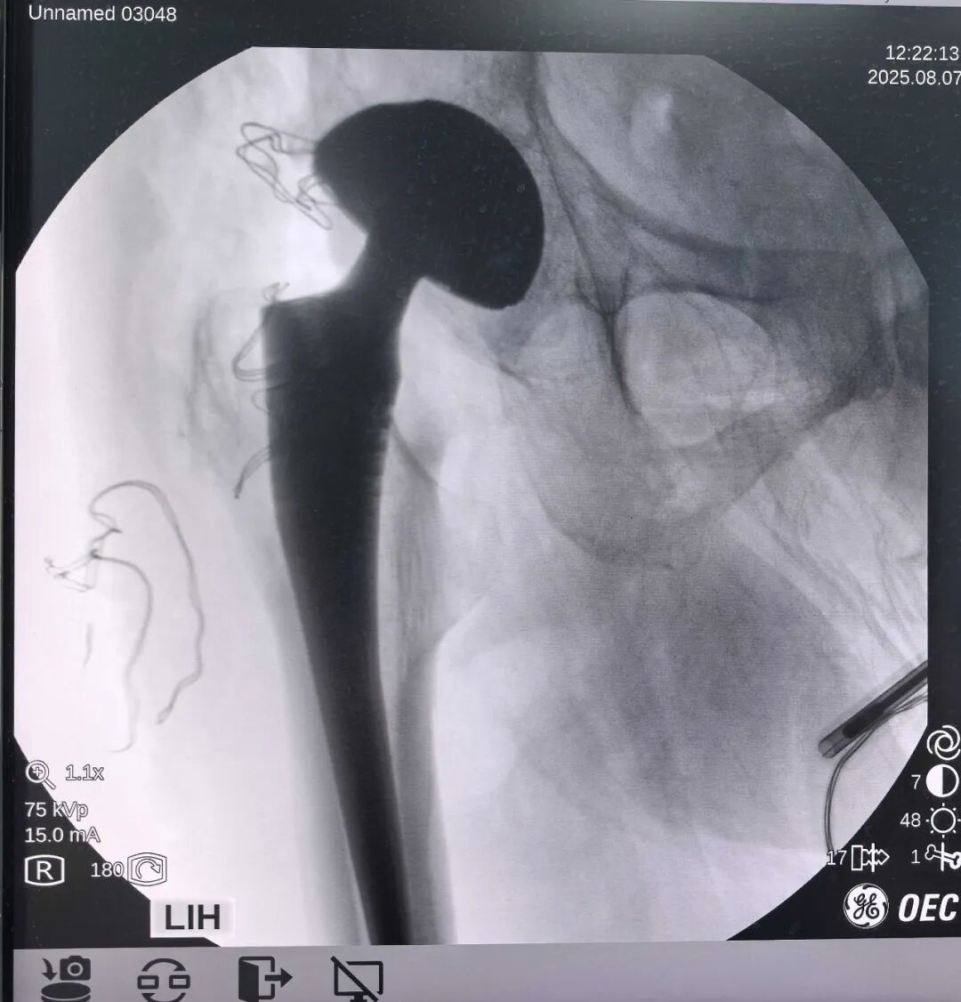 34张图文详解：21年融合髋THA的几点体会