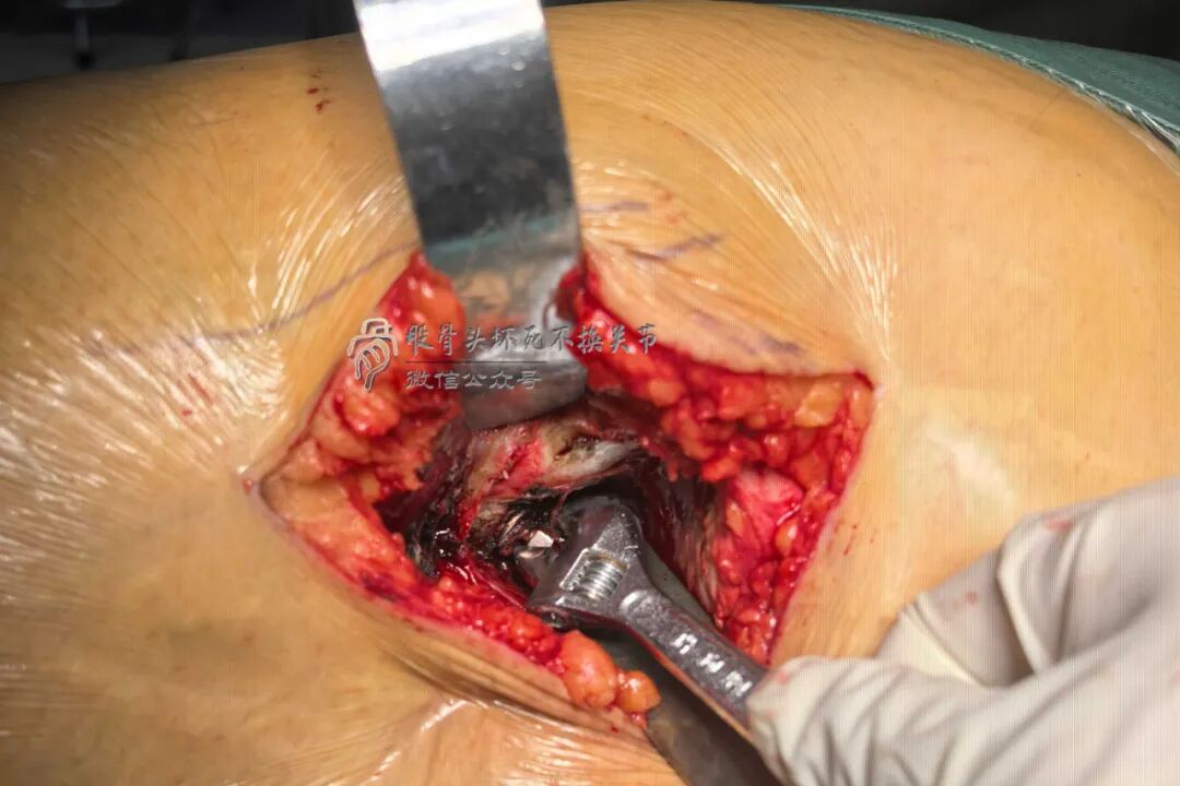 34张图文详解：21年融合髋THA的几点体会