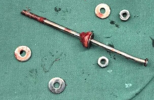 34张图文详解：21年融合髋THA的几点体会