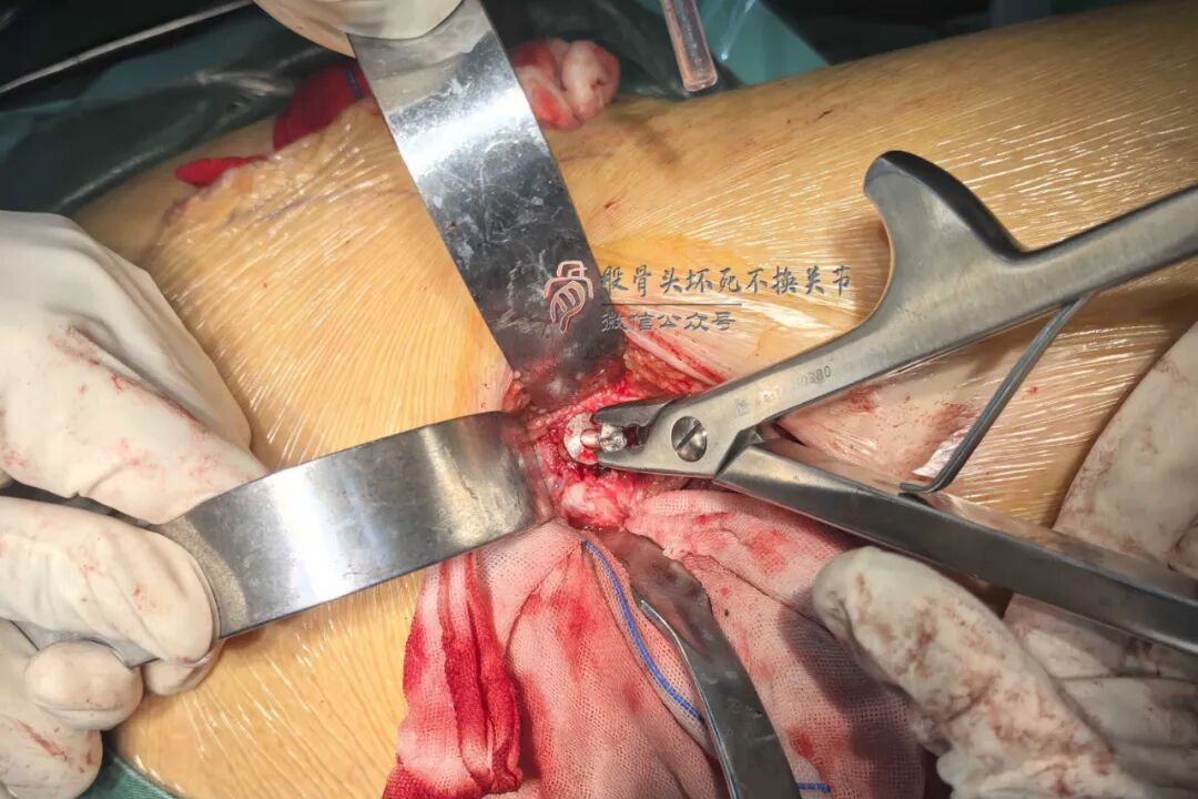 34张图文详解：21年融合髋THA的几点体会