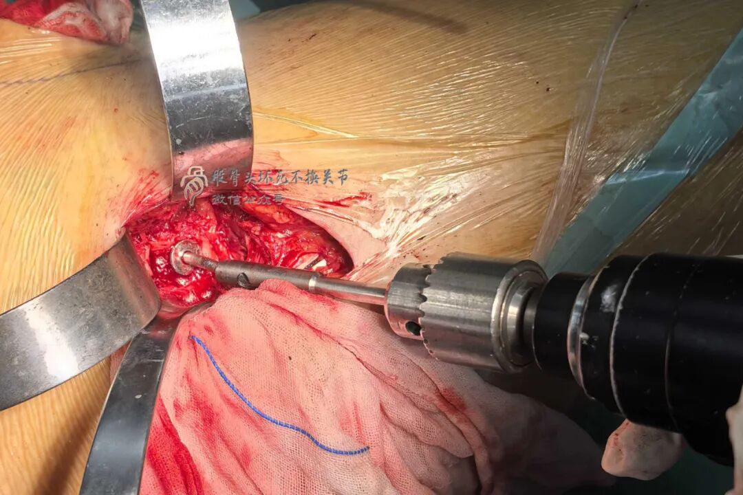 34张图文详解：21年融合髋THA的几点体会