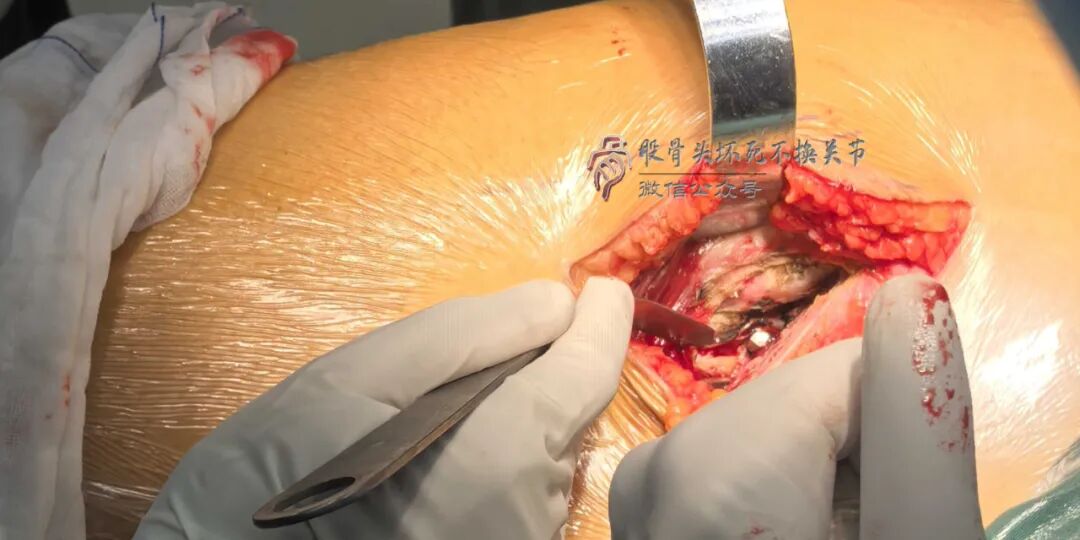 34张图文详解：21年融合髋THA的几点体会