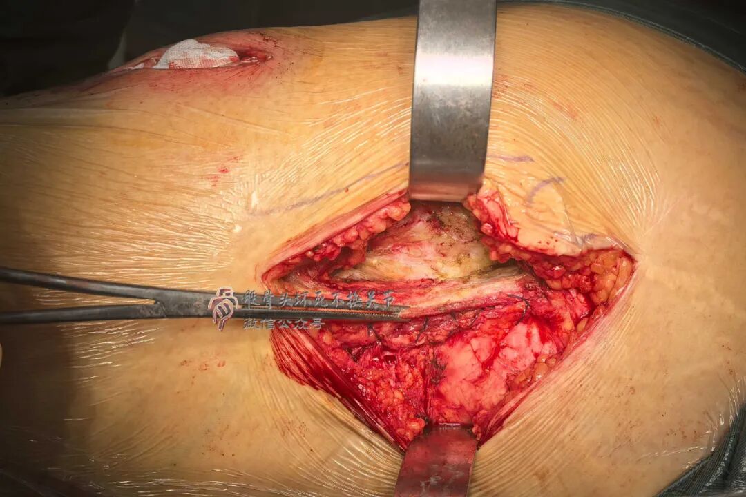 34张图文详解：21年融合髋THA的几点体会