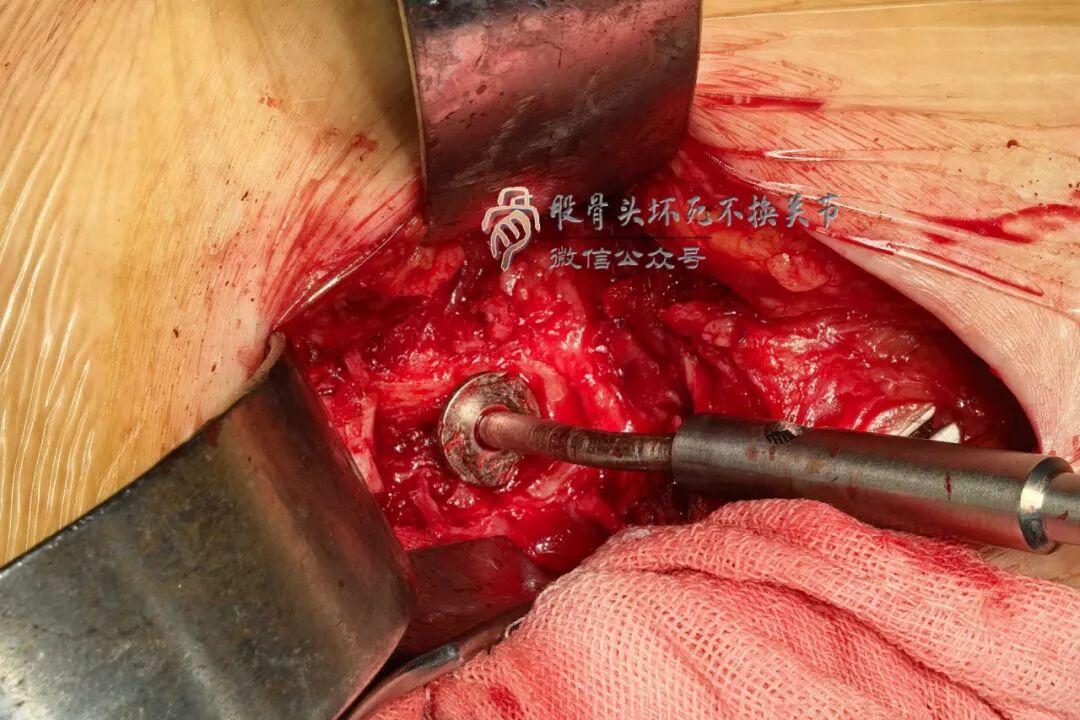 34张图文详解：21年融合髋THA的几点体会