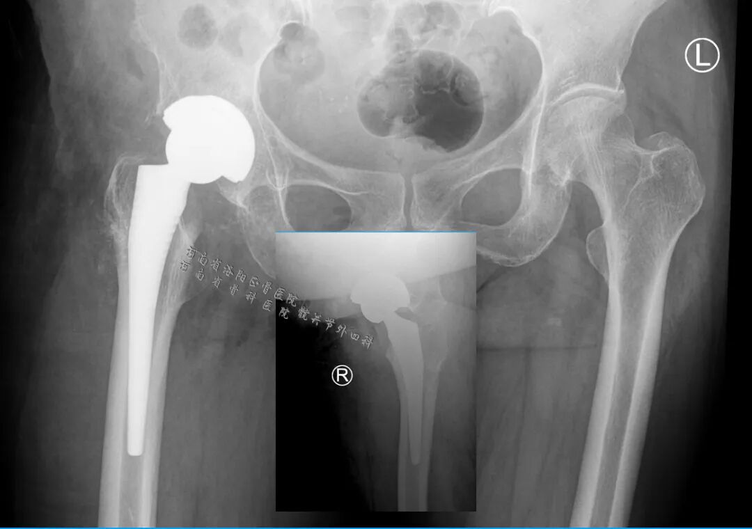 34张图文详解：21年融合髋THA的几点体会