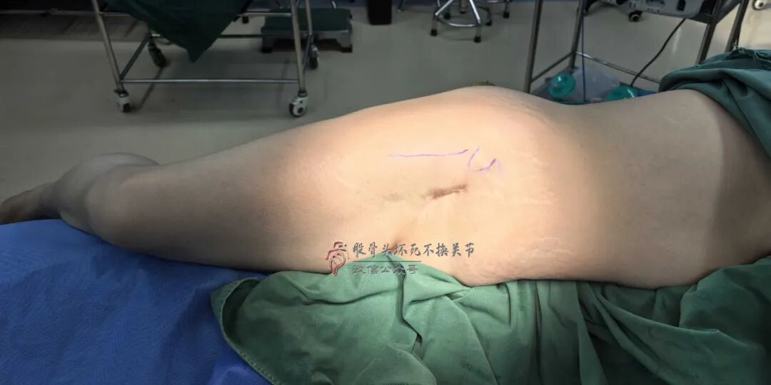 34张图文详解：21年融合髋THA的几点体会