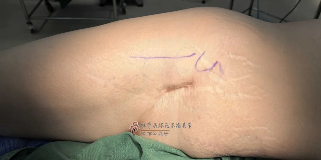 34张图文详解：21年融合髋THA的几点体会