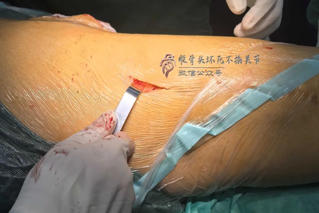 34张图文详解：21年融合髋THA的几点体会