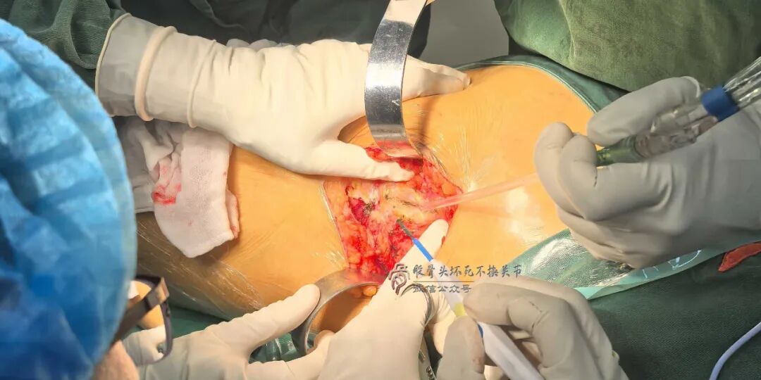 34张图文详解：21年融合髋THA的几点体会