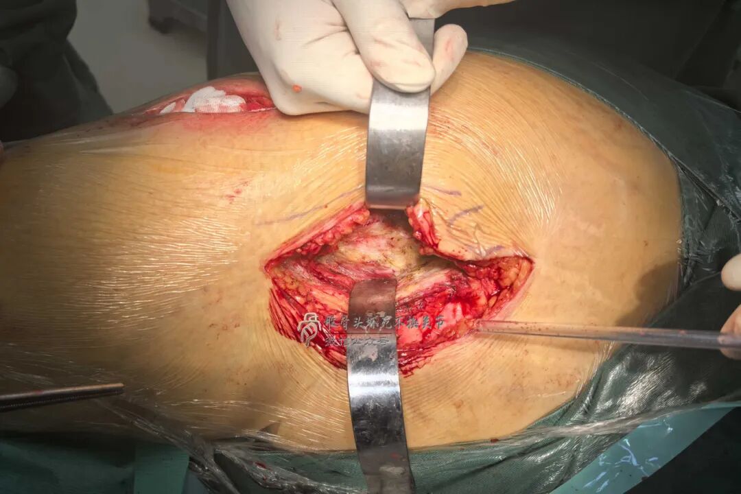 34张图文详解：21年融合髋THA的几点体会