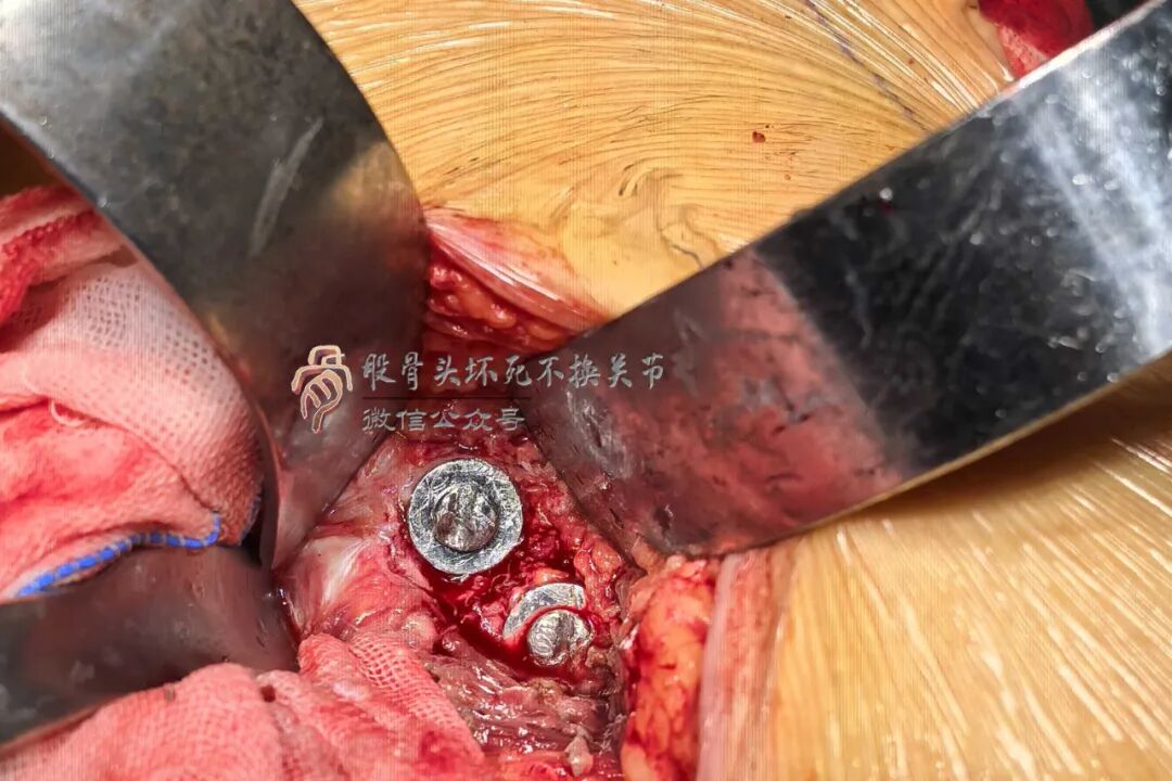 34张图文详解：21年融合髋THA的几点体会