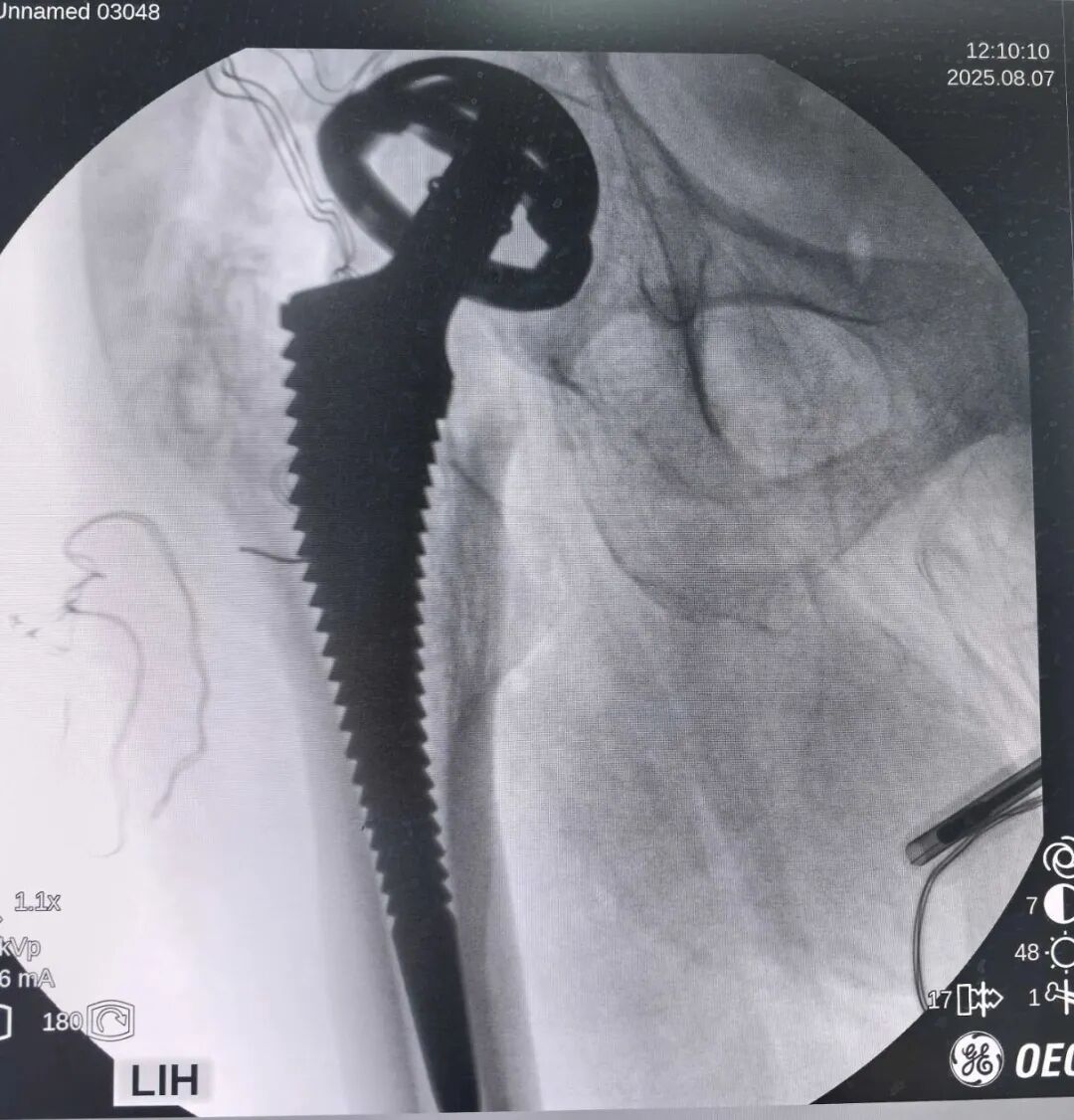 34张图文详解：21年融合髋THA的几点体会