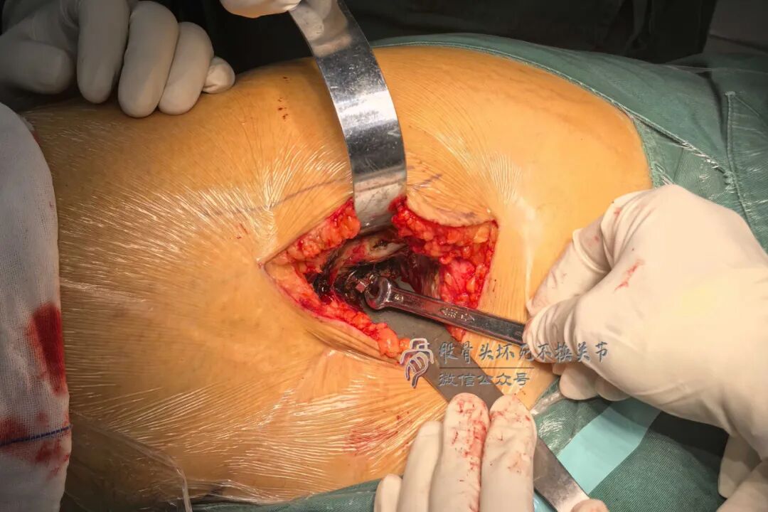 34张图文详解：21年融合髋THA的几点体会