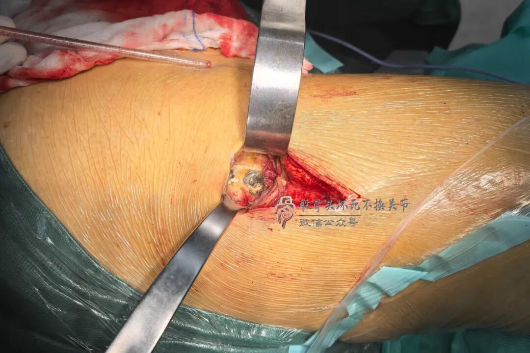 34张图文详解：21年融合髋THA的几点体会