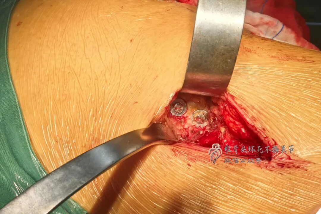 34张图文详解：21年融合髋THA的几点体会