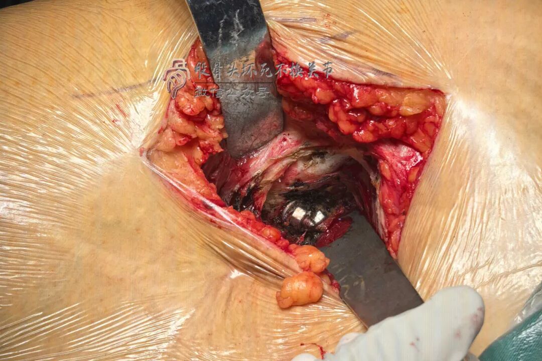 34张图文详解：21年融合髋THA的几点体会