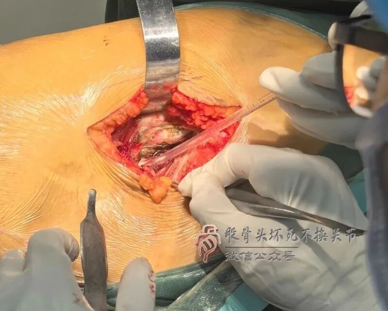 34张图文详解：21年融合髋THA的几点体会