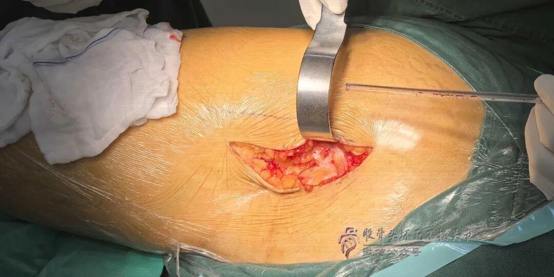 34张图文详解：21年融合髋THA的几点体会