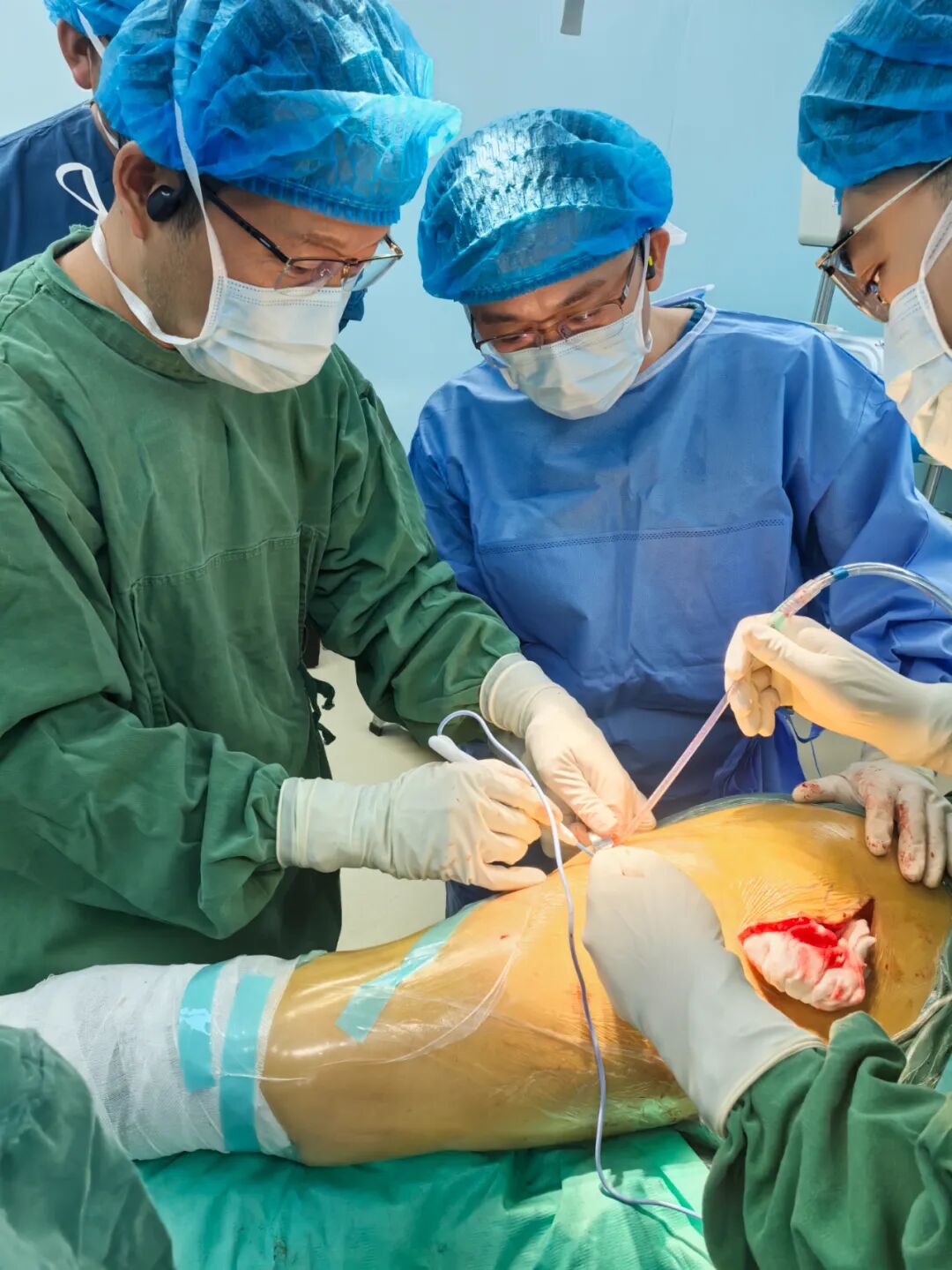 34张图文详解：21年融合髋THA的几点体会