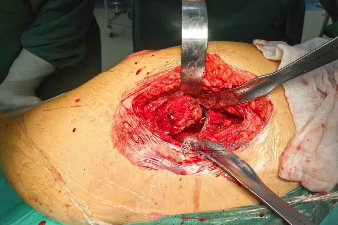 34张图文详解：21年融合髋THA的几点体会