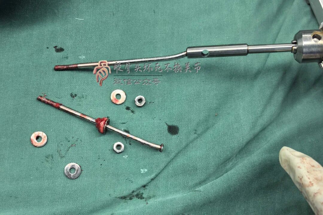 34张图文详解：21年融合髋THA的几点体会