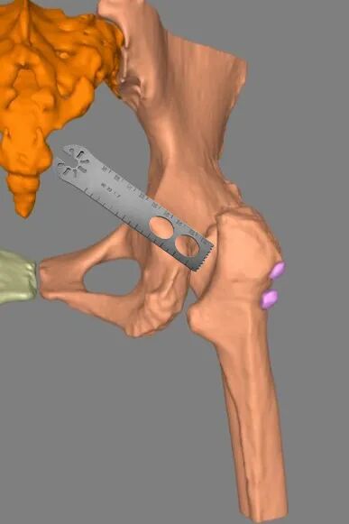 34张图文详解：21年融合髋THA的几点体会