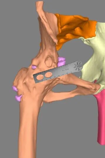 34张图文详解：21年融合髋THA的几点体会