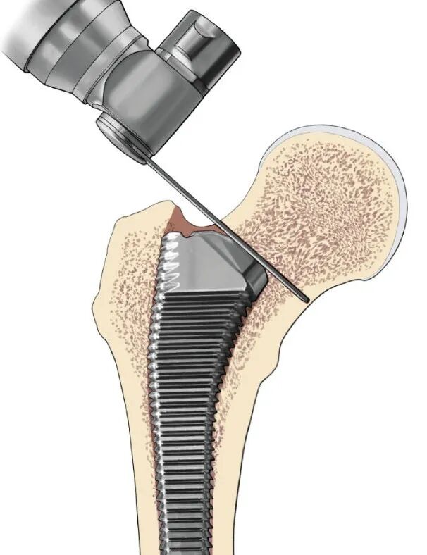 SuperPATH微创全髋关节置换手术入路图解