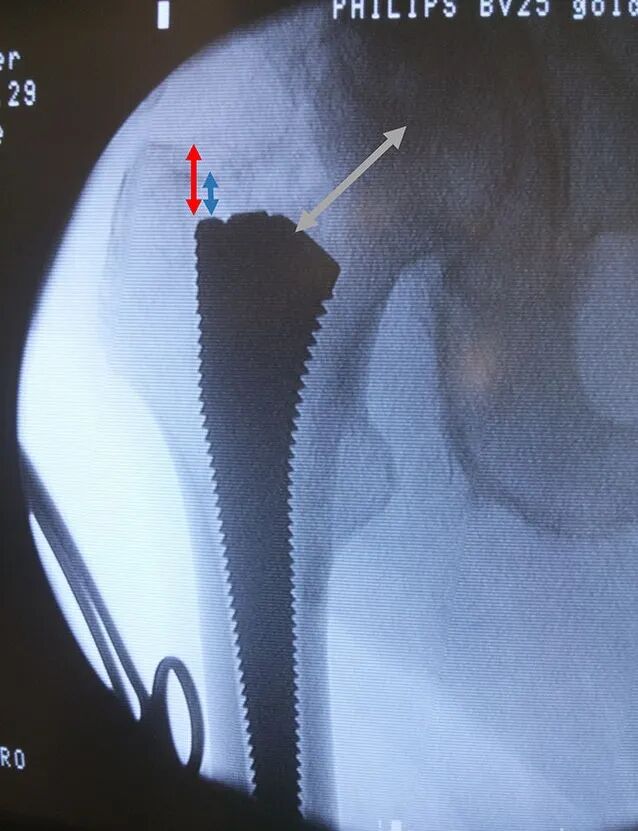 SuperPATH微创全髋关节置换手术入路图解