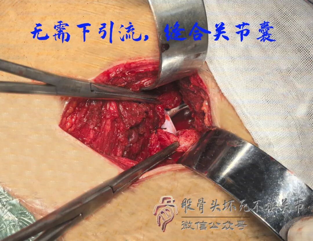 SuperPATH微创全髋关节置换手术入路图解