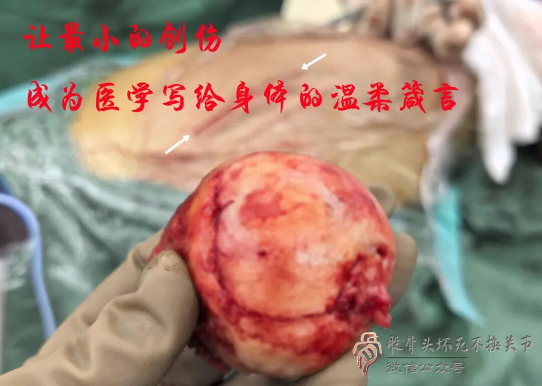 SuperPATH微创全髋关节置换手术入路图解