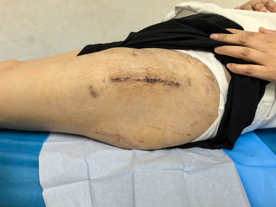 髋臼骨折4块板15颗钉，关节怎么换？