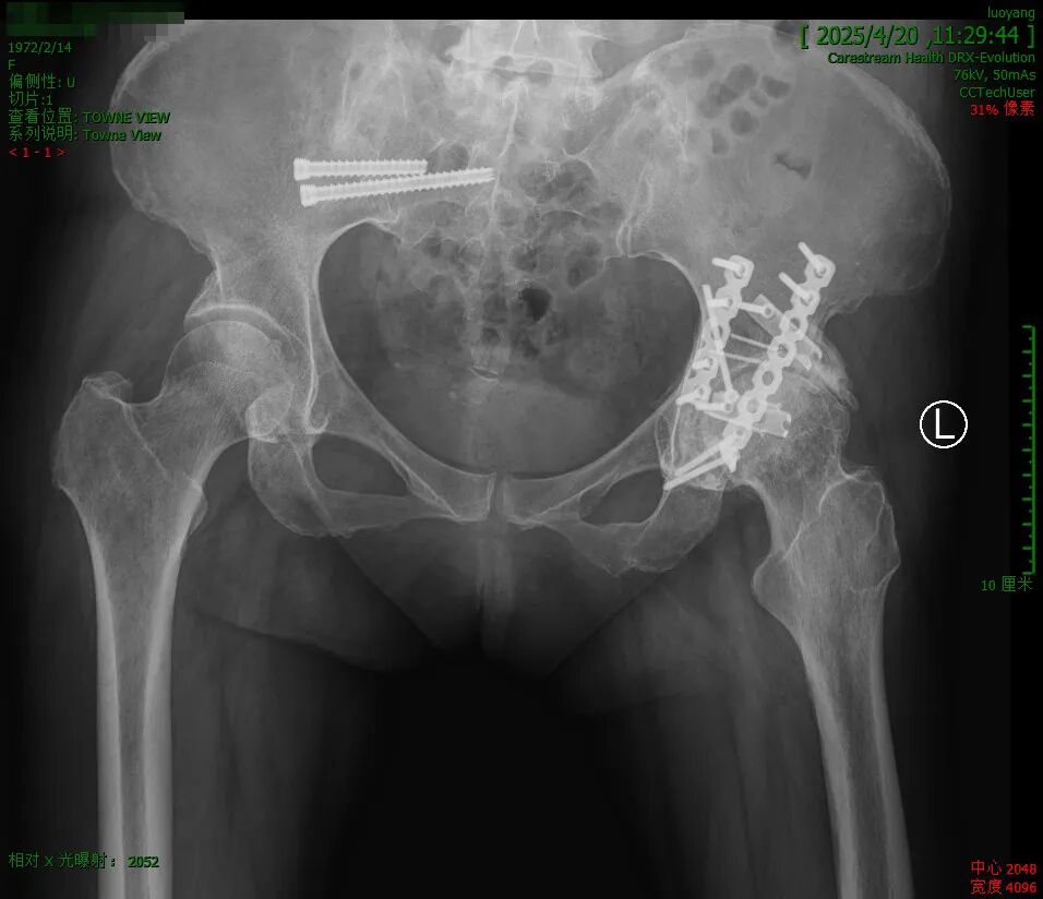 髋臼骨折4块板15颗钉，关节怎么换？