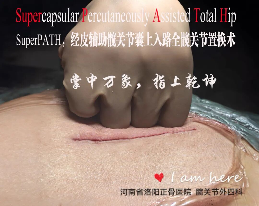 SuperPATH微创全髋关节置换手术入路图解