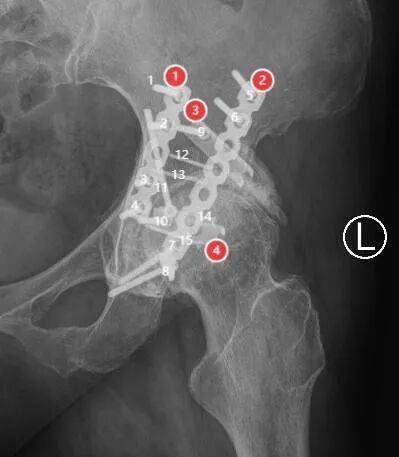髋臼骨折4块板15颗钉，关节怎么换？