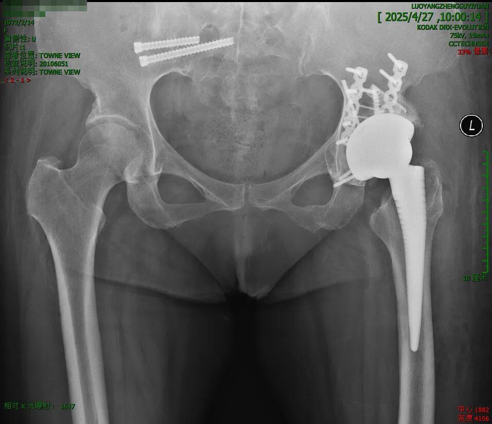 髋臼骨折4块板15颗钉，关节怎么换？