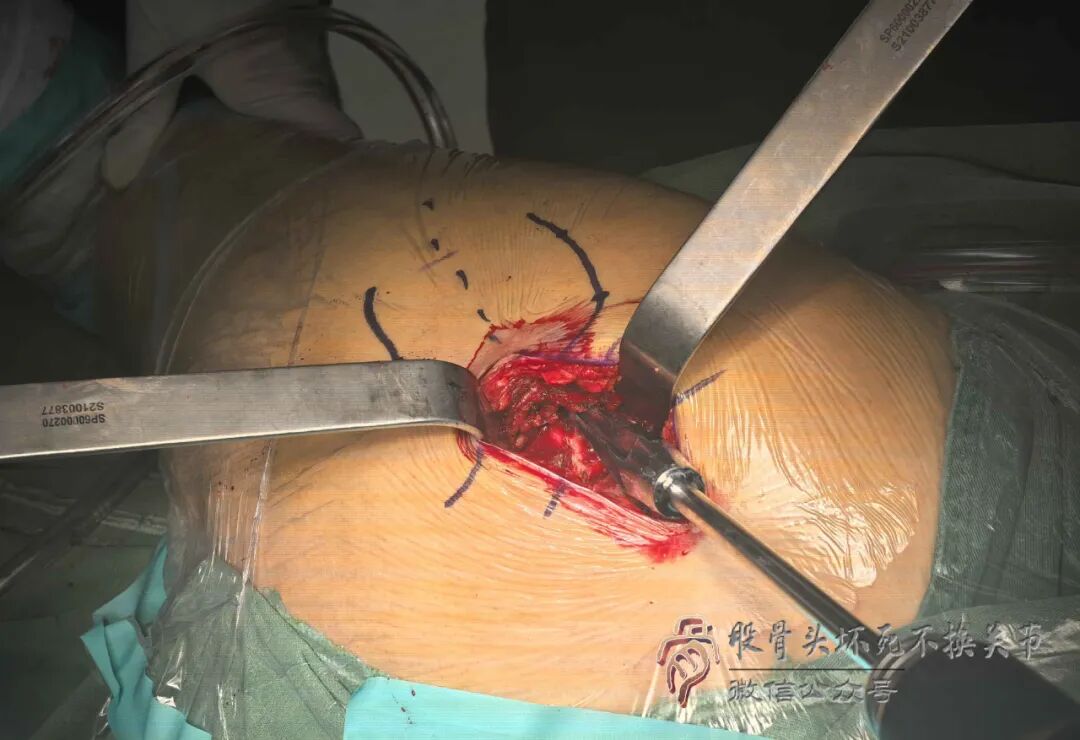 SuperPATH微创全髋关节置换手术入路图解