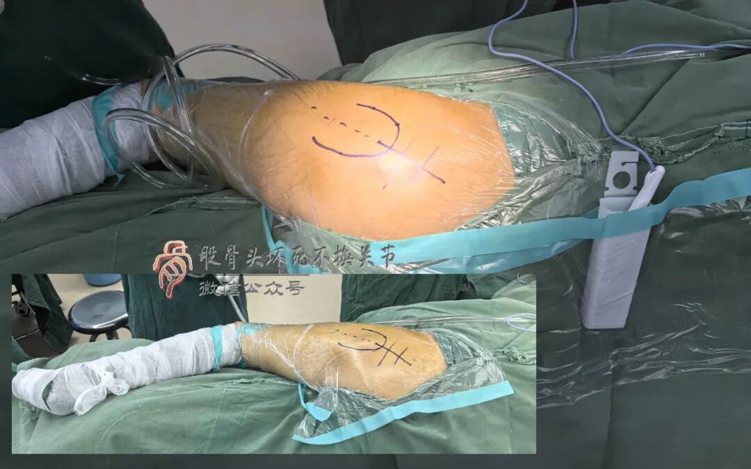 SuperPATH微创全髋关节置换手术入路图解