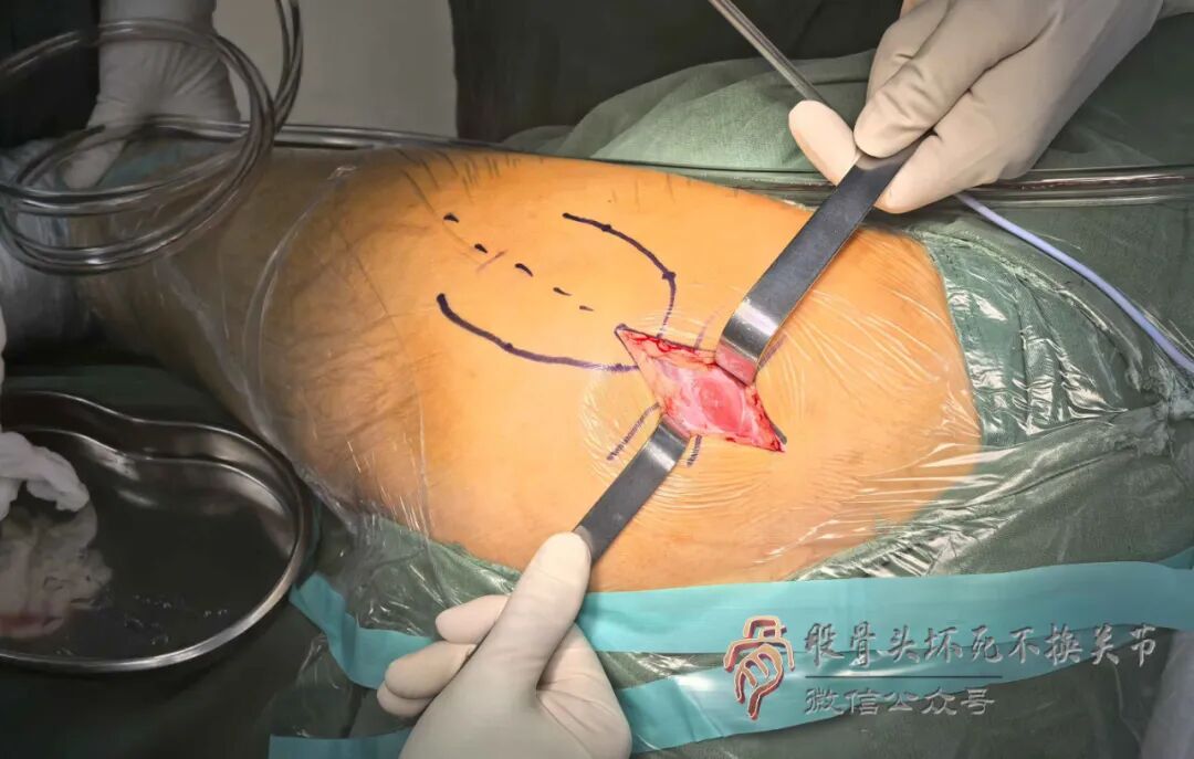 SuperPATH微创全髋关节置换手术入路图解