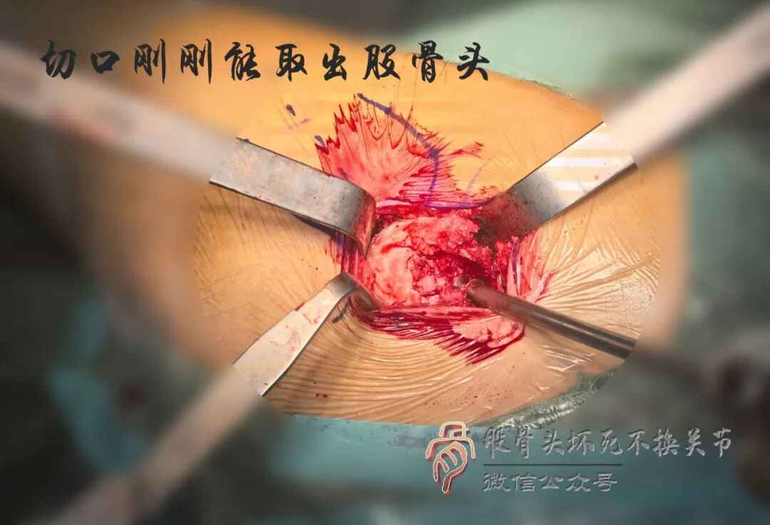 SuperPATH微创全髋关节置换手术入路图解