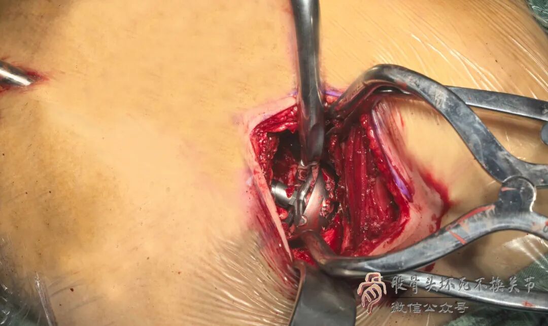 SuperPATH微创全髋关节置换手术入路图解