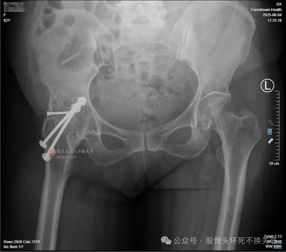 34张图文详解：21年融合髋THA的几点体会