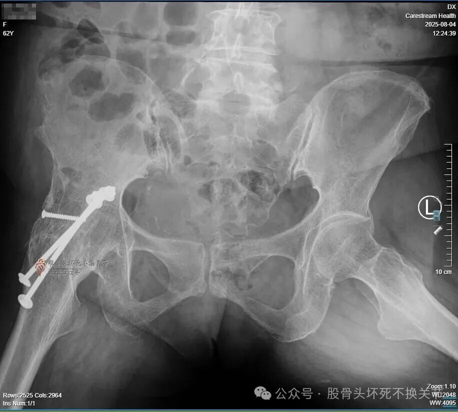 34张图文详解：21年融合髋THA的几点体会