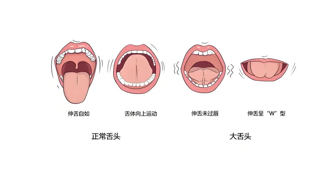 【瑞 · 科普】舌系带过短怎么办？