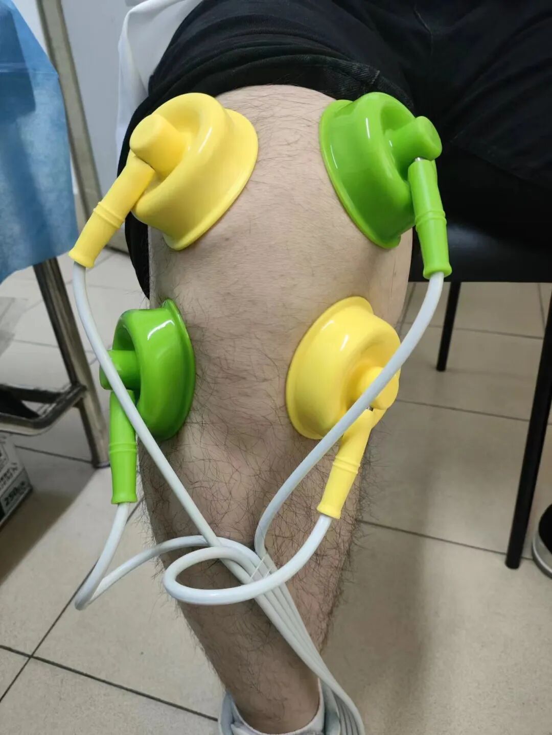 什么是中频干扰【小瑞康复说】康复理疗技术之“中频干扰电”的介绍_https://www.jmylbn.com_新闻资讯_第6张