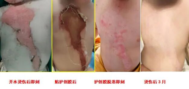 生物护创膜什么价位【科室动态】我院烧伤整形科推出新型“创可贴”式护创膜_https://www.jmylbn.com_新闻资讯_第2张