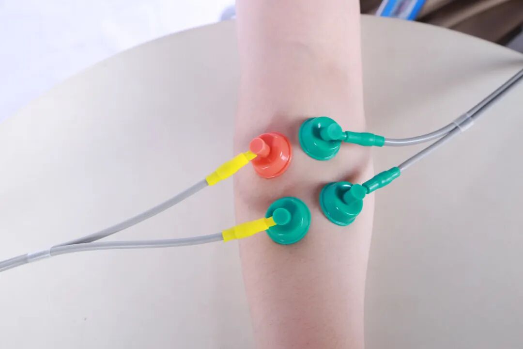 神经刺激仪怎么收费低频电疗—神经损伤治疗仪_https://www.jmylbn.com_新闻资讯_第8张