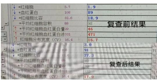 rbc直方图怎么看【安医科普】红细胞直方图解析_https://www.jmylbn.com_新闻资讯_第13张
